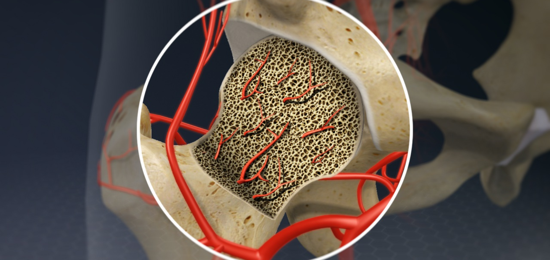 Saksham Ayurveda - A Natural Approach to Avascular Necrosis (AVN) Exploring Ayurveda's Potential